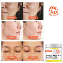 Load image into Gallery viewer, Turmeric Kojic Cleansing Pads